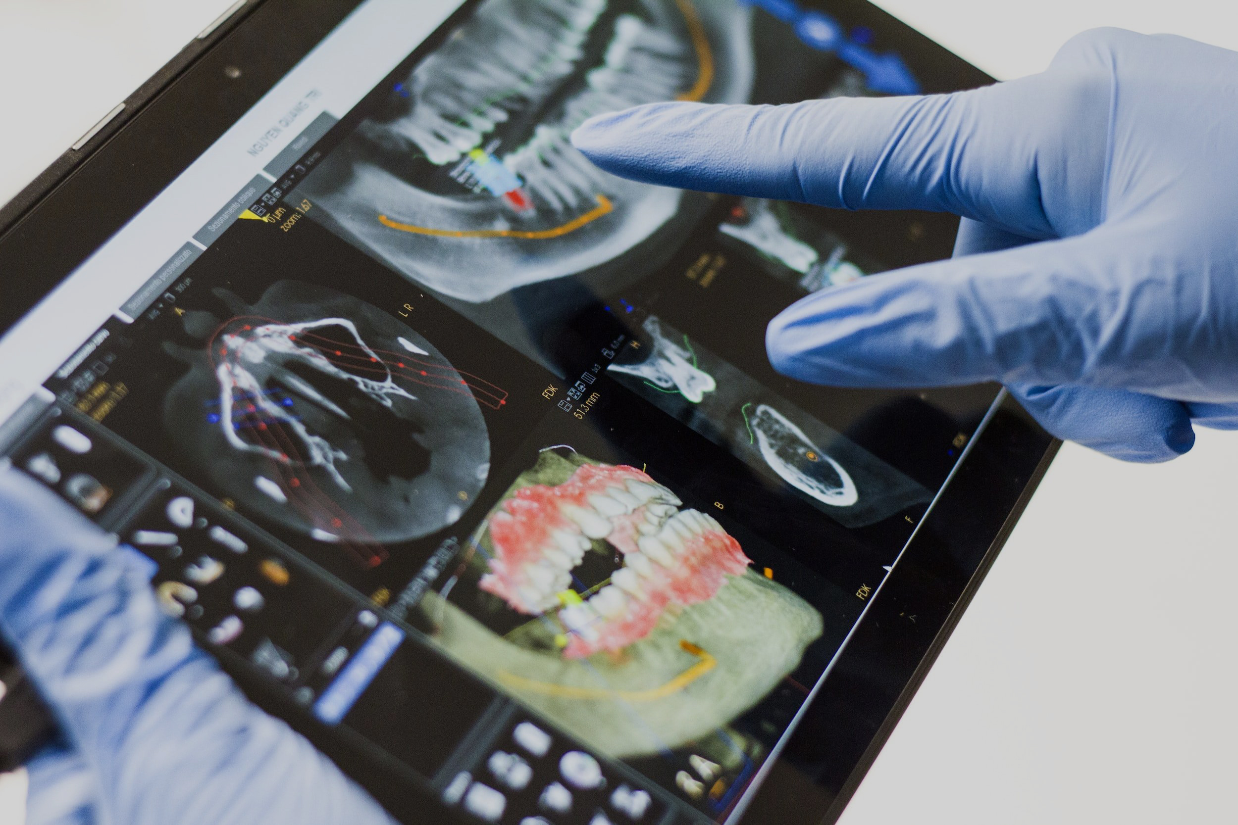 A dentist wearing gloves points to a digital X-ray of a patient's teeth and jaw on a tablet, analyzing the images for treatment planning - Dental Lab in Atlanta